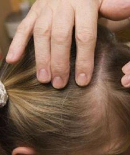PO VASAROS ATOSTOGŲ SVARBU PASIRŪPINTI PEDIKULIOZĖS PROFILAKTIKA