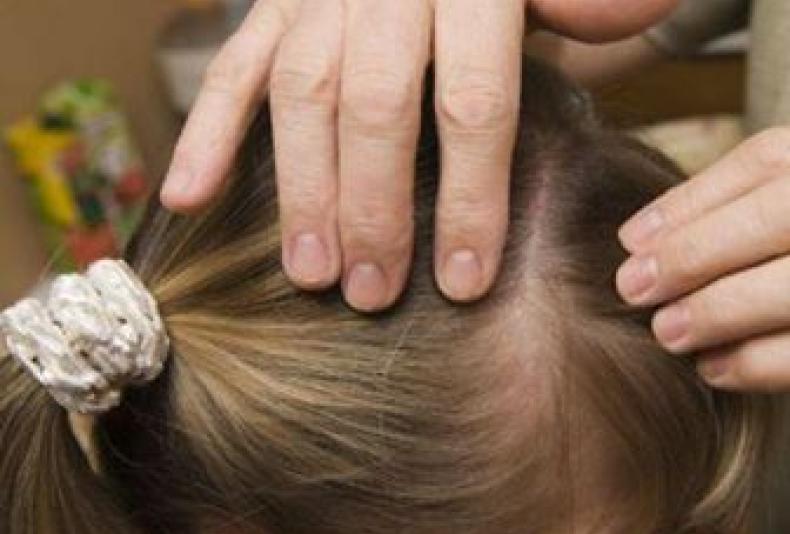 PO VASAROS ATOSTOGŲ SVARBU PASIRŪPINTI PEDIKULIOZĖS PROFILAKTIKA